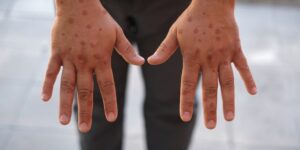 Men’s,Hands,Showing,Rash,Due,To,Pox,Viral,Infection,Painful Men’s,Hands,Showing,Rash,Due,To,Pox,Viral,Infection,Painful